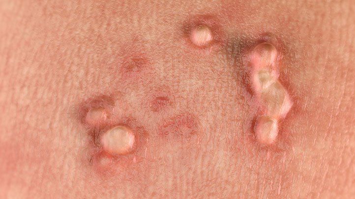 Genital Warts and Infections